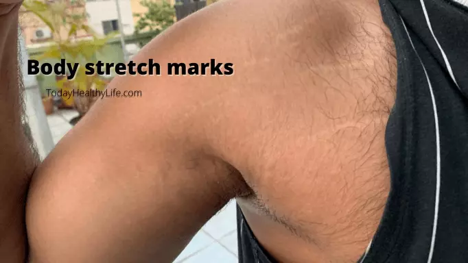 Body stretch marks