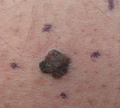 Malignant Melanoma