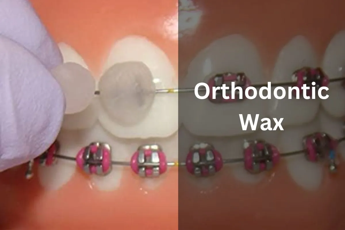 Orthodontic Wax 101: How to Use, Where to Buy & More